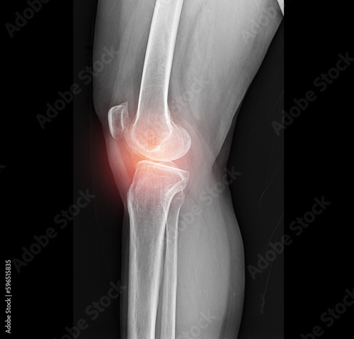 Inflamed knee joints  pain  x-ray images