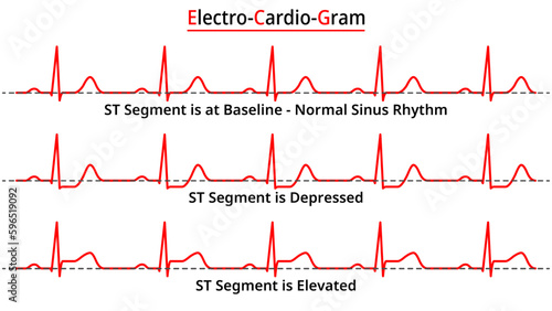 Set of ECG Common Abnormalities - Elevated ST Segment vs Depressed ST Segment - Normal Sinus Rhythm - Medical Vector and Illustration
