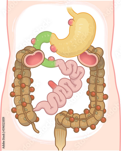 大腸憩室・憩室穿孔・憩室・Diverticulum・メッケル憩室・メッケル憩室癌のイラスト