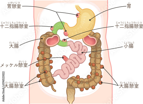 大腸憩室・憩室穿孔・憩室・Diverticulum・メッケル憩室・メッケル憩室癌のイラスト