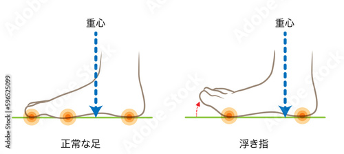 正常な足の重心と、浮き指の足の重心