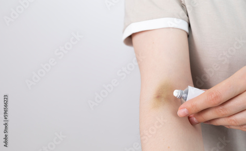 Someone Applies Healing Cream, Ointment On Hematoma, Bruise After Injection, Blood Sampling From Metal Tube. Cure.Post-injection phlebitis. Copyspace For Text. Horizontal plane. photo