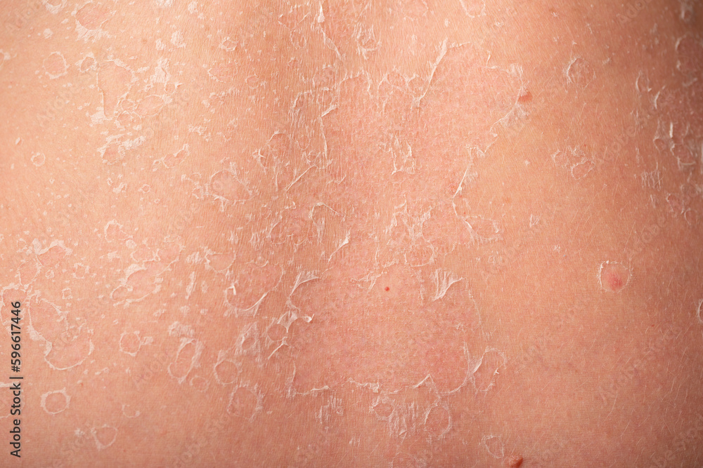 Sunburn, close-up of human skin. Flaky skin from allergies, peeling or eczema. Dry skin in need of treatment and hydration.