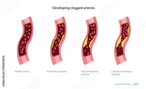 Cholesterol deposits (plaques) in the heart arteries and inflammation are usually the cause of coronary artery disease. Artery blockage vector illustrations.