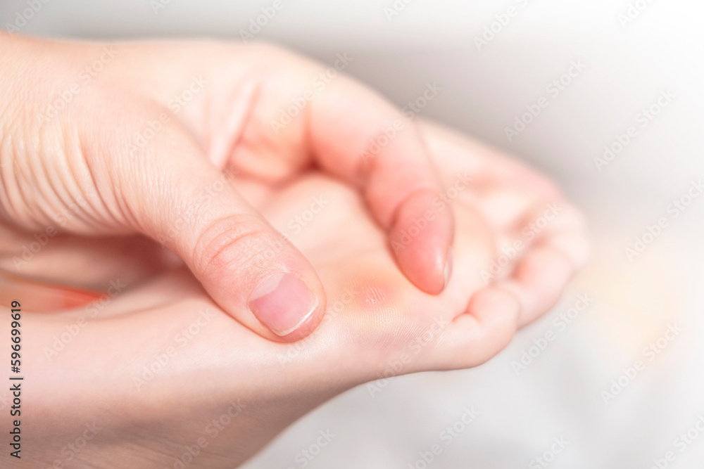 Close up of calluses. Problem skin on the steps of a teenager Close up of calluses. Problem skin on the steps of a teenager