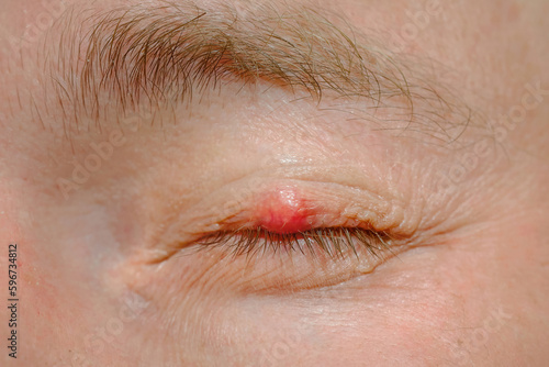 Eyelid sickness. Demodicosis mite diseas, demodex. Chalazion on eyelid. Eye disease and treatment. Inflammation of eyelashes hair follicle, Demodex folliculitis. Scales on skin and eyelashes, eczema