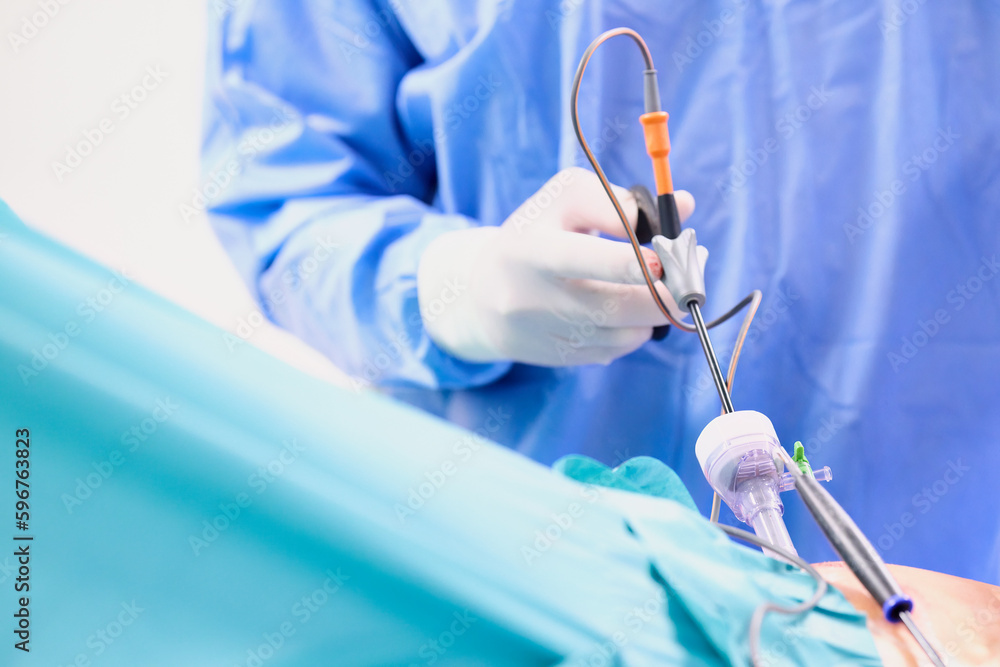 Operacja laparoskopowa na sali operacyjnej w szpitalu. Dłonie chirurga w sterylnych rękawiczkach trzymają narzędzia endoskopowe. Asysta instrumentariuszki. - obrazy, fototapety, plakaty 