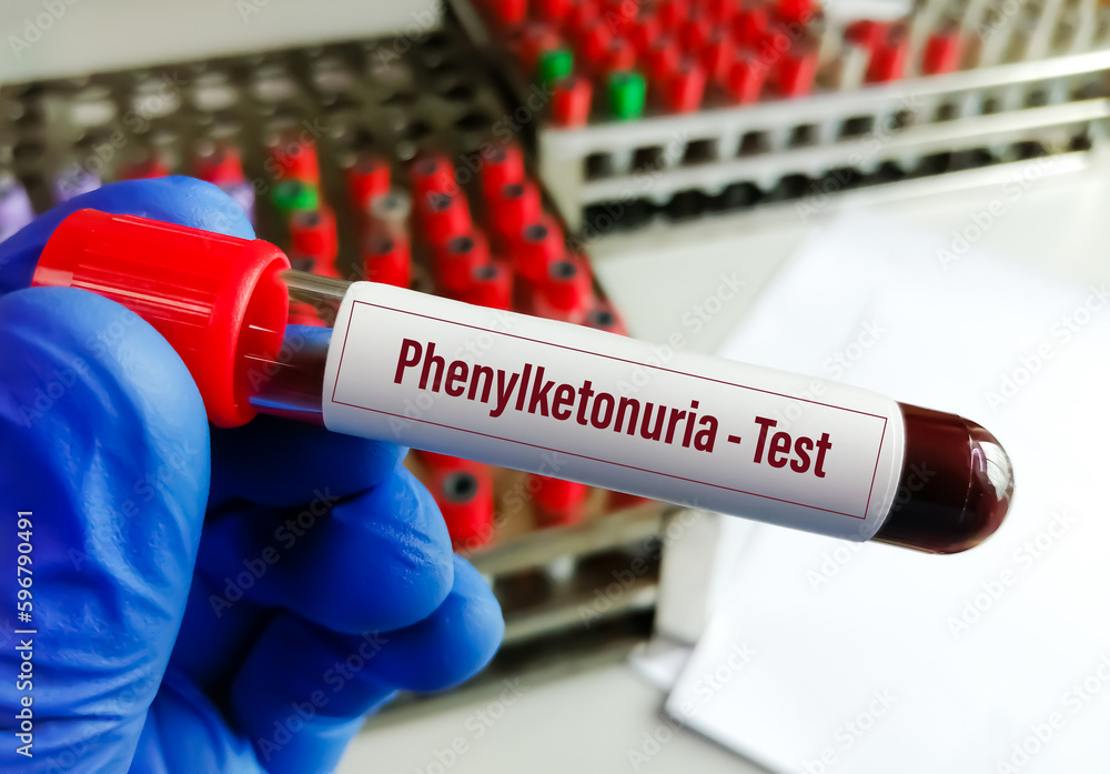 Blood sample for Phenylketonuria (PKU) test is an inherited disorder Blood sample for Phenylketonuria (PKU) test is an inherited disorder
