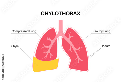 Chylothorax anatomical poster