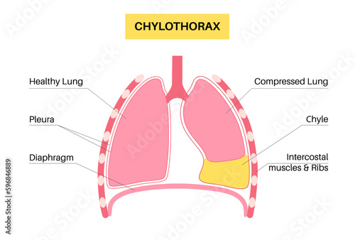 Chylothorax anatomical poster