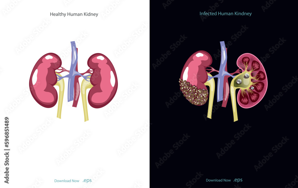 Chronic kidney disease, also called chronic kidney failure, involves a