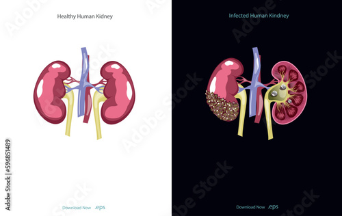 Chronic kidney disease, also called chronic kidney failure, involves a gradual loss of kidney function. Your kidneys can't filter wastes and excess fluids from your blood. Vector illustration.