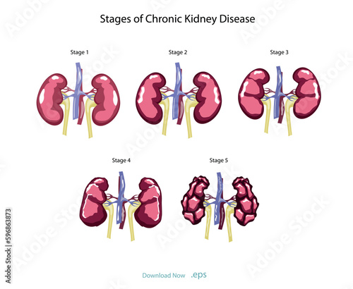 Chronic kidney failure, involves a gradual loss of kidney function. Your kidneys can't filter wastes and excess fluids from your blood. Vector illustration.