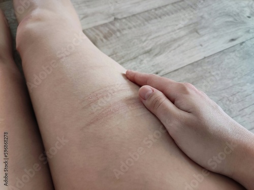 leg with traces of scars after self-harm, the concept of psychology and autoaggression photo