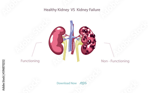 Chronic kidney failure, involves a gradual loss of kidney function. Your kidneys can't filter wastes and excess fluids from your blood. Vector illustration.