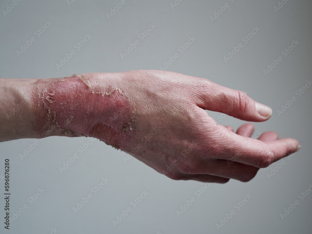 skin-burn