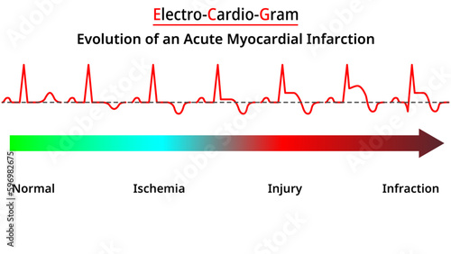 Evolution of an Acute Myocardial Infarction - Vectors and Illustrations for Medical Purposes