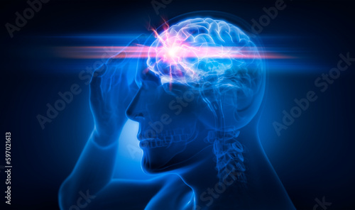 Man with Severe Headache or Migraine with dark background - Medical X Ray Illustration - 3D Illustration