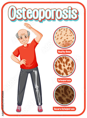 Comparison of normal bone and bone with Osteoporosis in old people