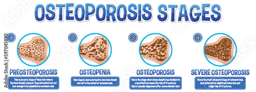Informative poster of Osteoporosis human bone