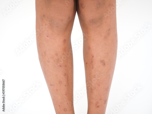 Boy's legs with many red spot and scar from insect bites. Closeup photo, blurred.