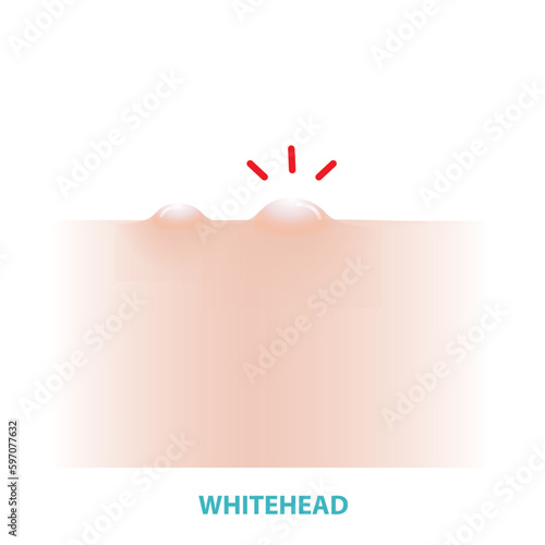 Whitehead acne vector illustration isolated on white background. Formation of comedone, whitehead, a pale or white-topped pustule on the skin. Flat design vector acne illustration.