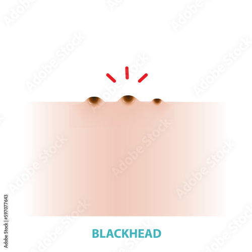 Blackhead acne vector isolated on white background. Formation of comedone, blackhead, a plug of sebum in a hair follicle, darkened by oxidation on the skin. Flat design vector acne illustration.