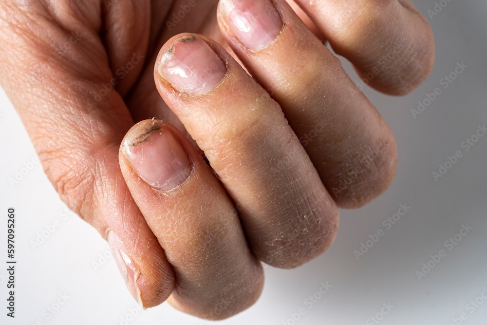 The manifestation of a lack of trace elements in the body. Destruction