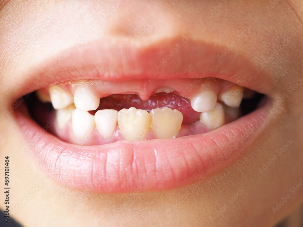 Fototapeta premium Young boy lost her first bottom front milk teeth and upper front teeth. Childhood health care concept. Closeup photo, blurred.