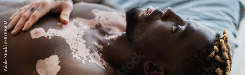 Shirtless african american man with vitiligo resting on bed at home, banner.