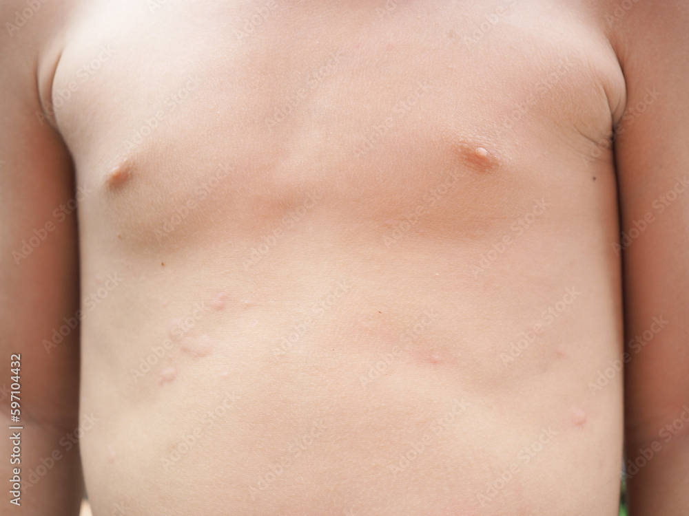 Asian kid's body rash is caused by urticaria, food allergies, insect bites. health concept. Closeup photo, blurred.