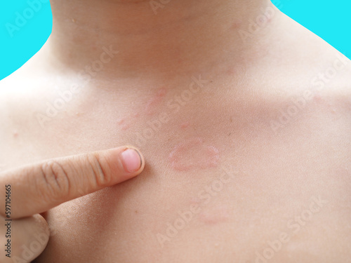 Kid's chest rash is caused by urticaria, food allergies, insect bites. health concept. Closeup photo, blurred.