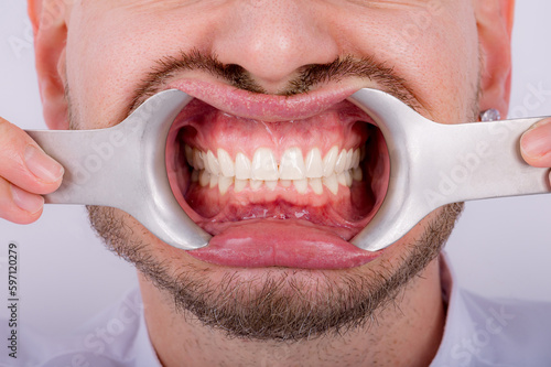 Man patient with stainless lips retractor in dental clinic