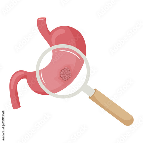  Stomach cancer. Malignant cancerous tumor enlarged under magnifying glass. Anatomical vector illustration isolated white background cartoon style