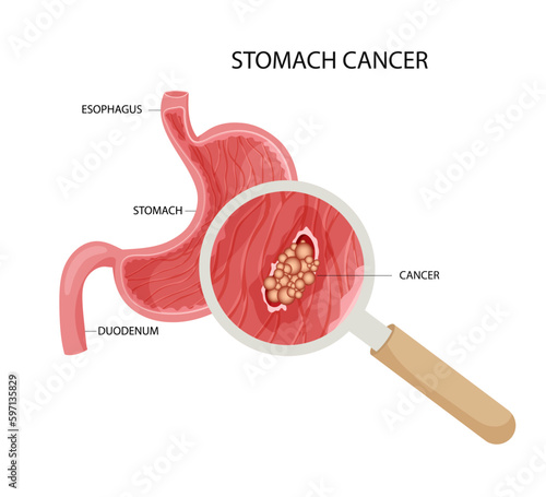  Stomach cancer. Malignant cancerous tumor enlarged under magnifying glass. Anatomical vector illustration isolated white background cartoon style