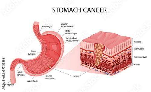 Stomach cancer. Malignant cancerous tumor. Anatomical vector illustration isolated white background cartoon style