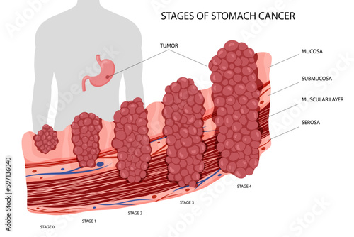 Stomach cancer. Stages growth malignant cancerous tumor. Anatomical vector illustration isolated white background cartoon style