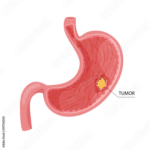 Stomach cancer. Malignant cancerous tumor. Anatomical vector illustration isolated white background cartoon style