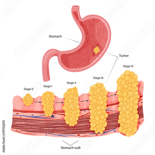 Stomach cancer. Stages growth malignant cancerous tumor. Anatomical vector illustration isolated white background cartoon style