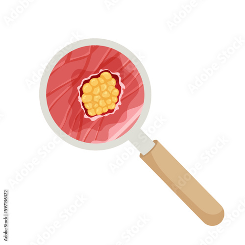  Cancer. Malignant cancerous tumor enlarged under magnifying glass. Anatomical vector illustration isolated white background cartoon style