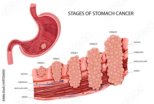 Stomach cancer. Stages growth malignant cancerous tumor. Anatomical vector illustration isolated white background cartoon style