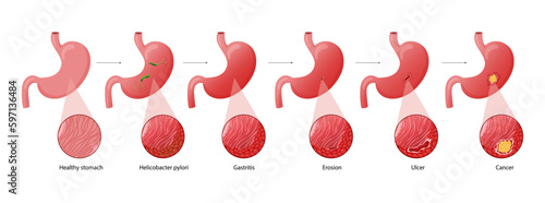 Stomach diseases. Diagram of diseases of helicobacter pylori, gastritis, erosion, ulcer and cancer. Educational anatomical vector illustration