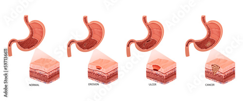 Stomach diseases. Diagram of diseases gastritis, erosion, ulcer and cancer. Educational anatomical vector illustration