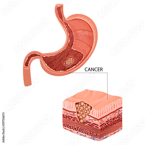 Stomach cancer. Malignant cancerous tumor. Anatomical vector illustration isolated white background cartoon style