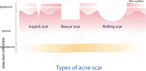 Types of acne scar vector on white background. Cross section of icepick scar, boxcar scar and rolling scar with skin layer. Skin care and beauty concept illustration. photo