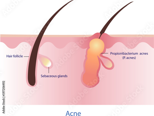 Cause of acne with skin surface vector on white background. Skin care and beauty concept illustration.