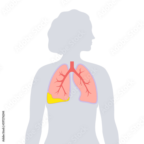Pyothorax pleural empyema
