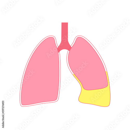 Chylothorax anatomical poster photo