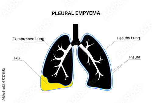 Pyothorax pleural empyema