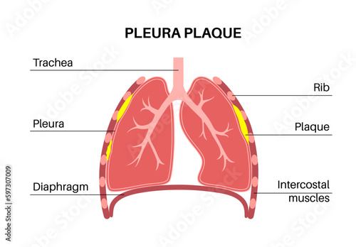 Pleural plaque poster